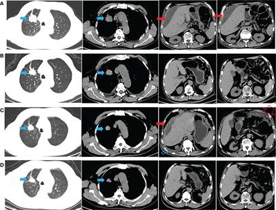 Case Report: A patient with the rare third-generation TKI-resistant mutation EGFR L718Q who responded to afatinib plus cetuximab combination therapy